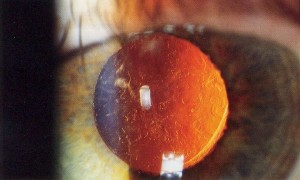 YAG Laser Posterior Capsulotomy