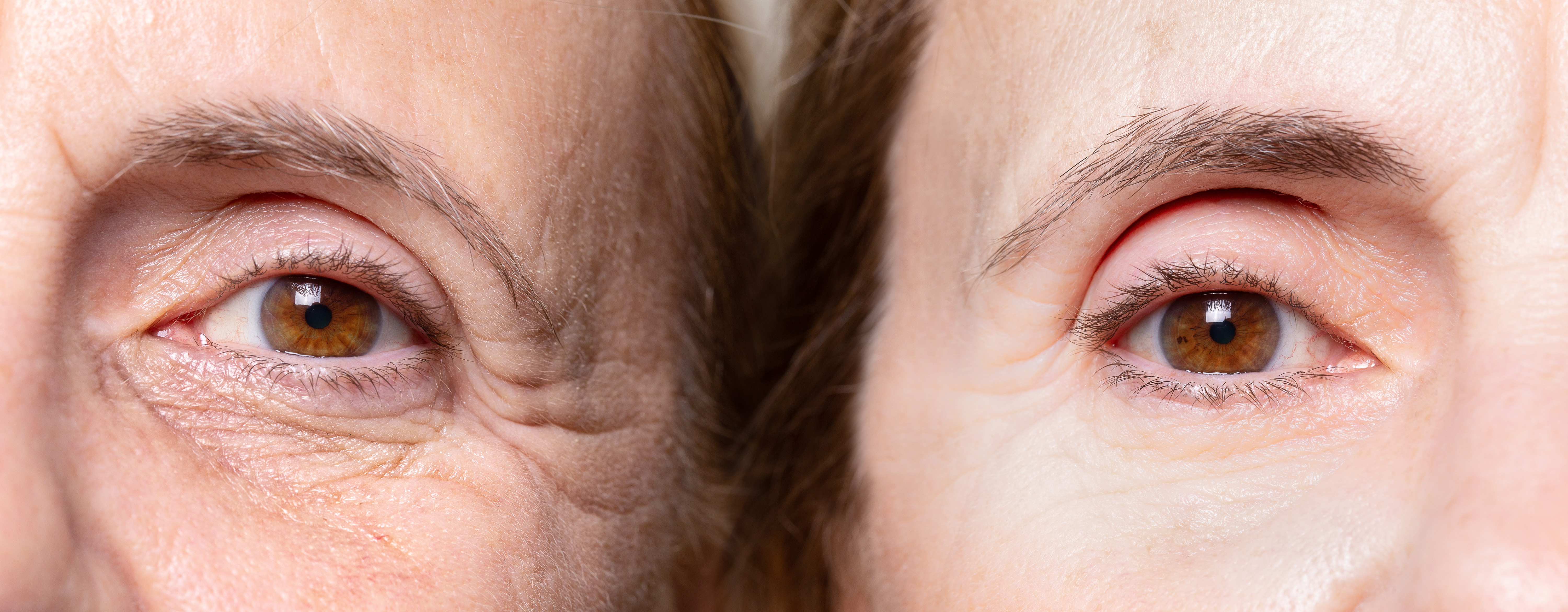 Before and After of Botox Treatment