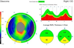 OCT Eye Test Glaucoma