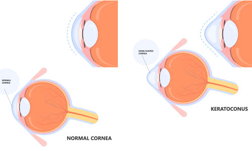 Keratoconus Treatment