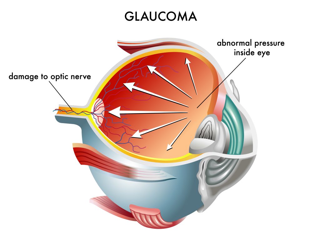 Glaucoma diagnosis